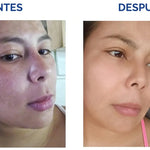2X1 Tónico despigmentante MTC 100% efectivo + Obsequio Gratis 2 Bloqueador