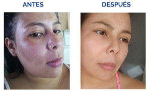 2X1 Tónico despigmentante MTC 100% efectivo + Obsequio Gratis 2 Bloqueador