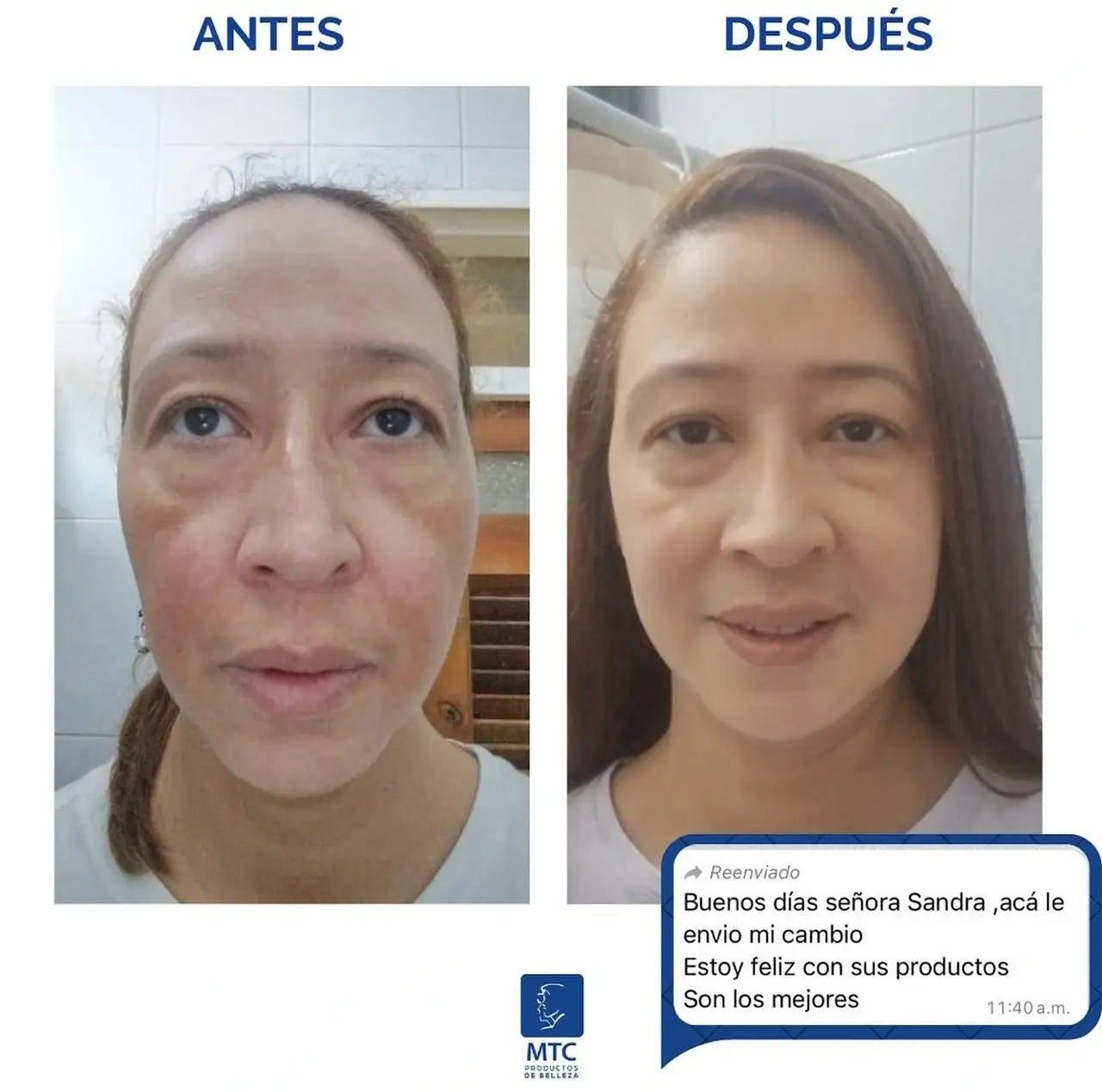 2X1 Tónico despigmentante MTC 100% efectivo + Obsequio Gratis 2 Bloqueador
