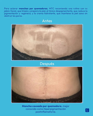 2X1 Tónico despigmentante MTC 100% efectivo + Obsequio Gratis 2 Bloqueador
